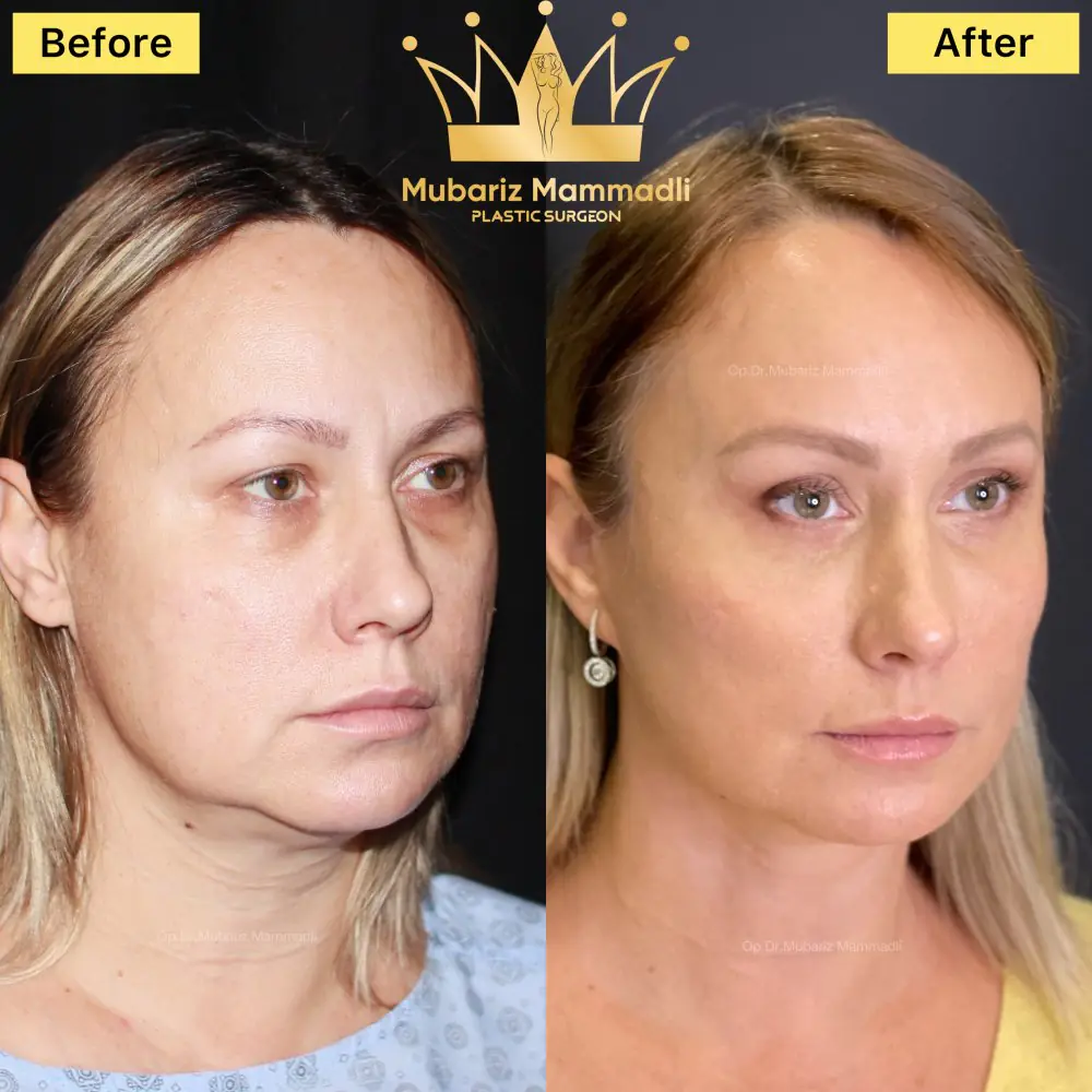 Before and after result for natural facial contouring