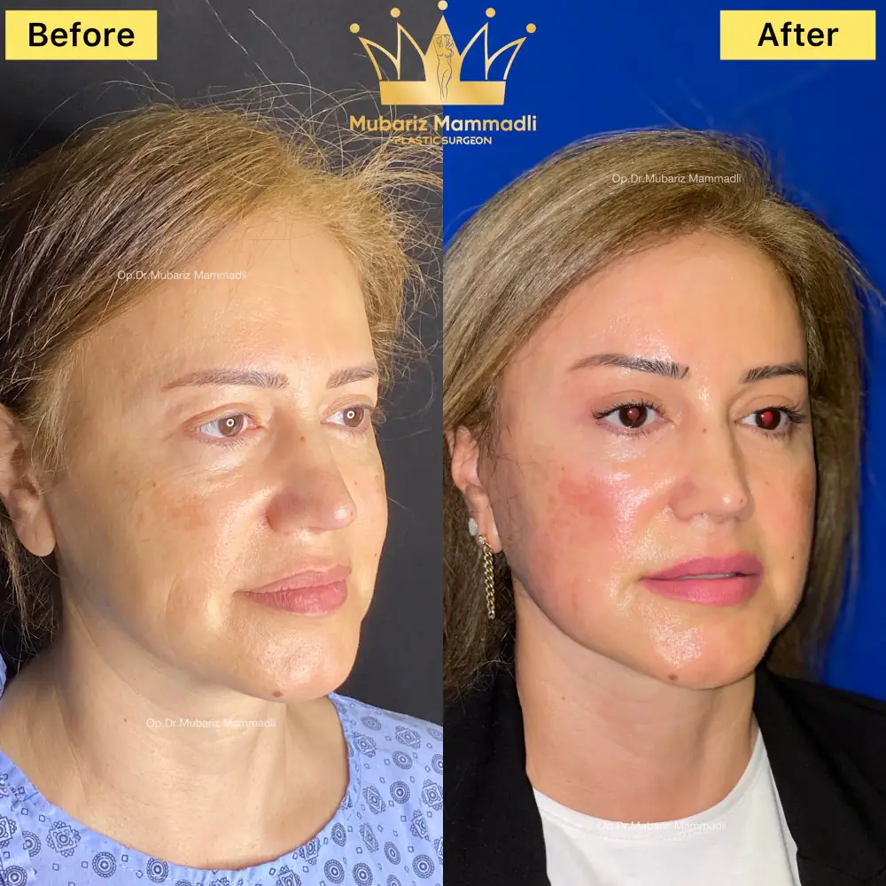 Before and after result for refined facial features