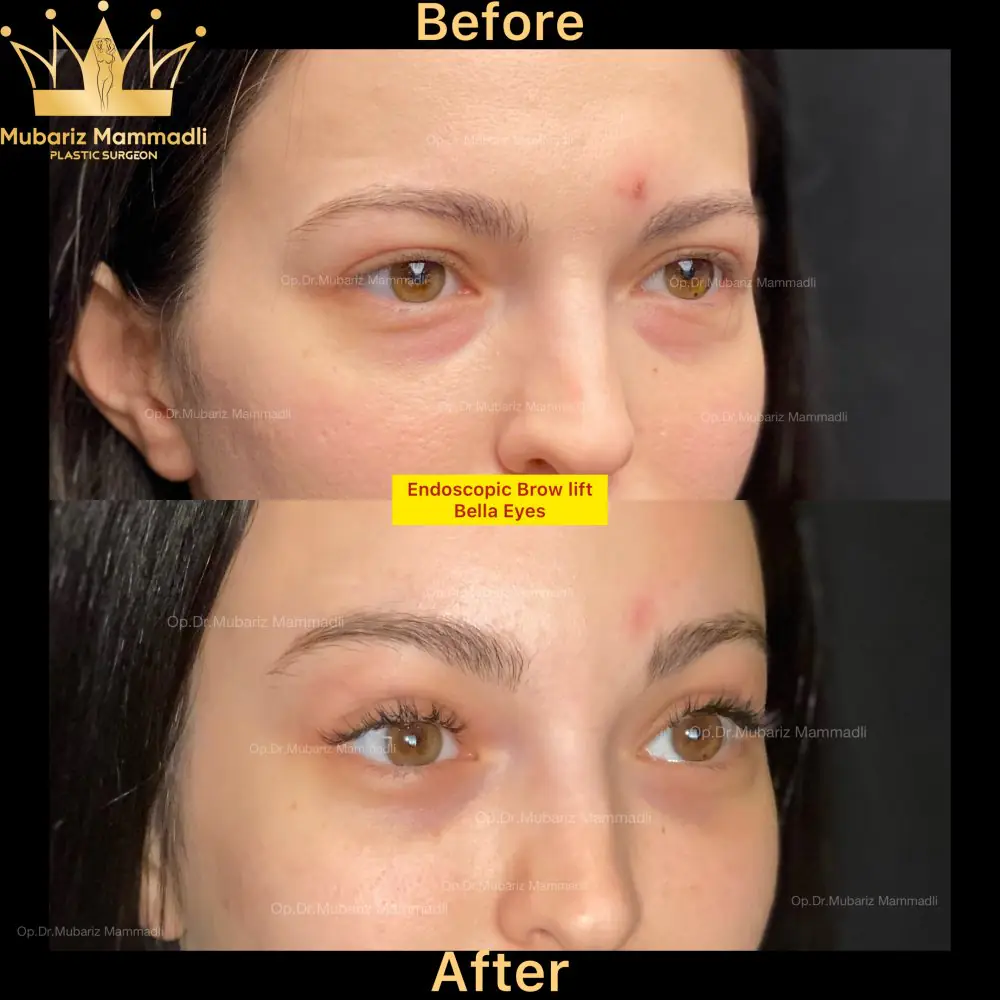 Before and after result for the eye area
