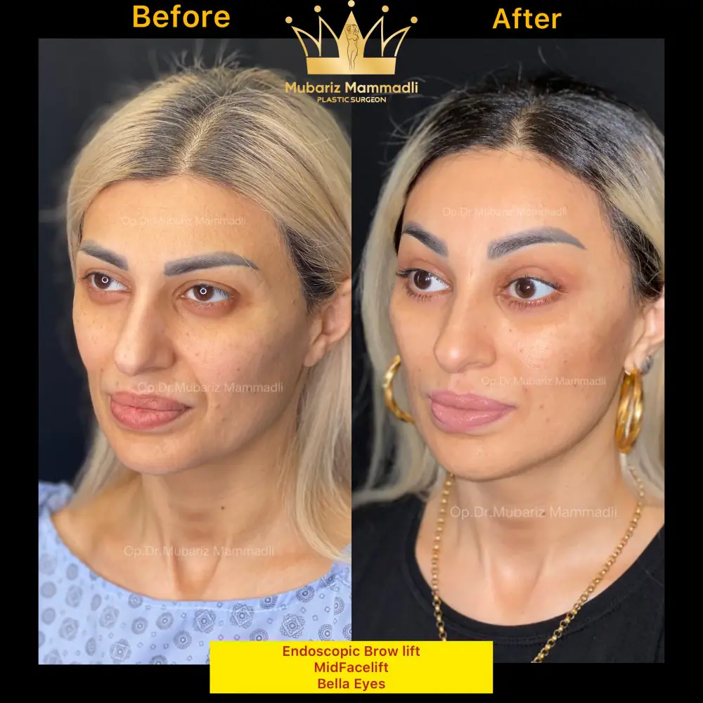 Before and after result for the periocular area