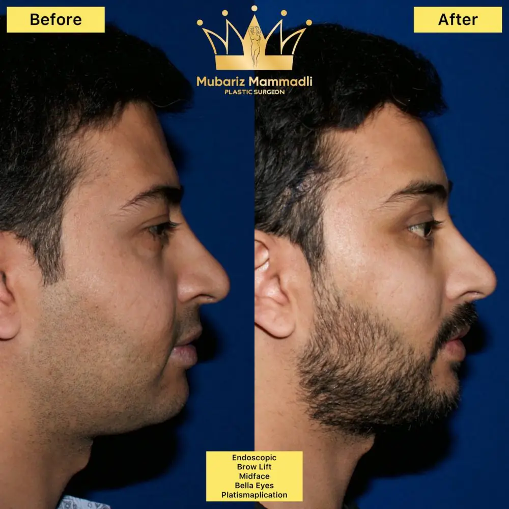 Before and after result for male facial profile