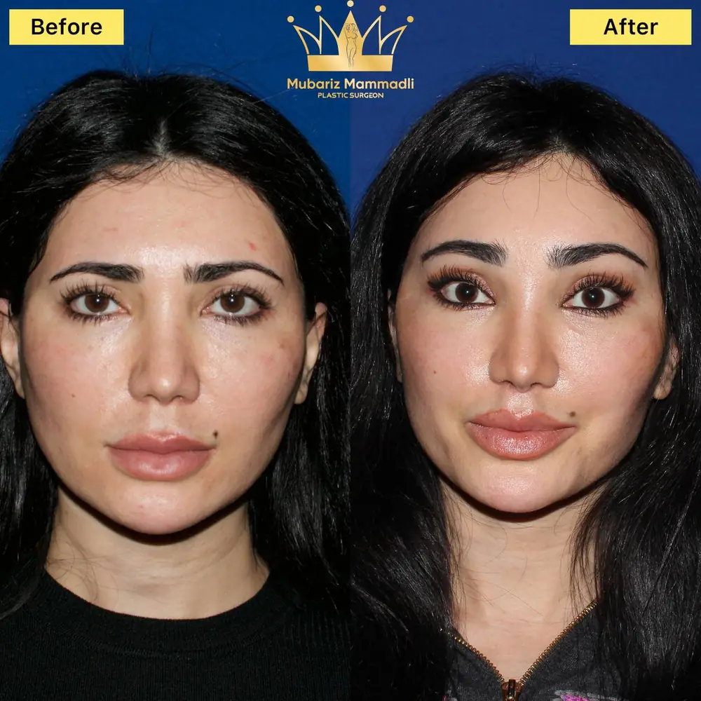Before and after result for discreet facial refinement