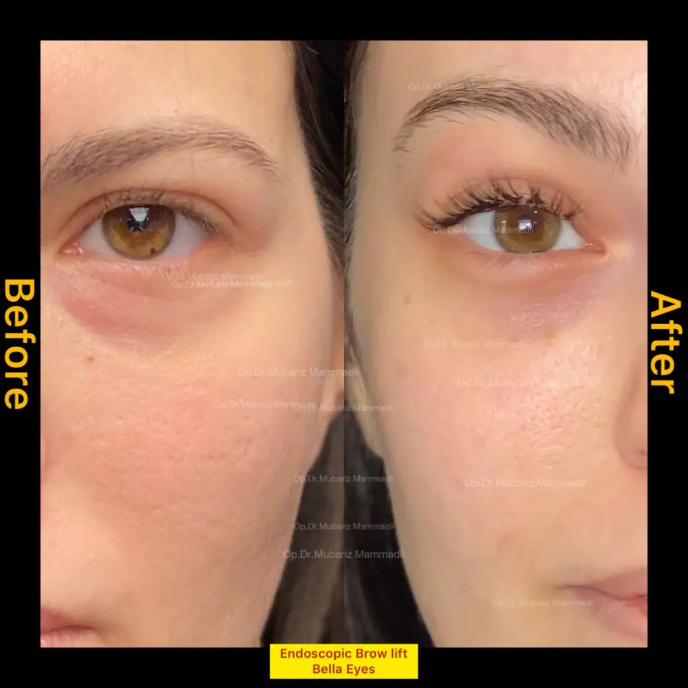 Before and after result for refreshed eye appearance