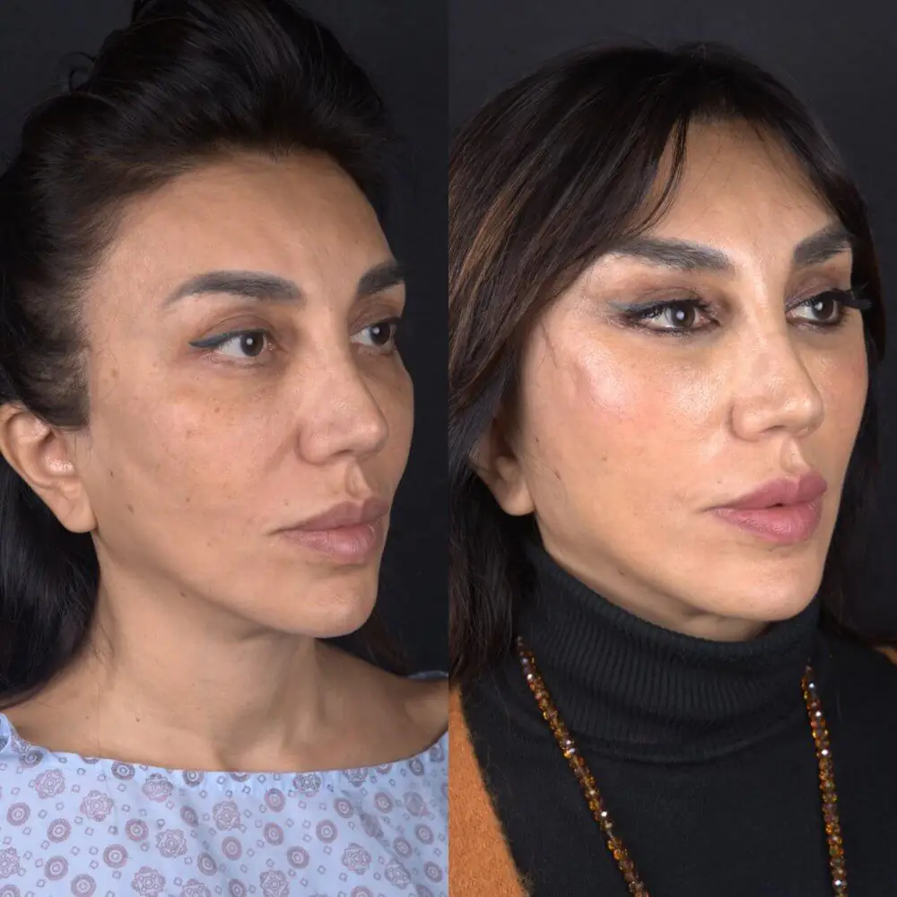 Before and after result for facial profile harmonization